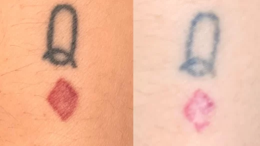 Laser Tattoo Removal