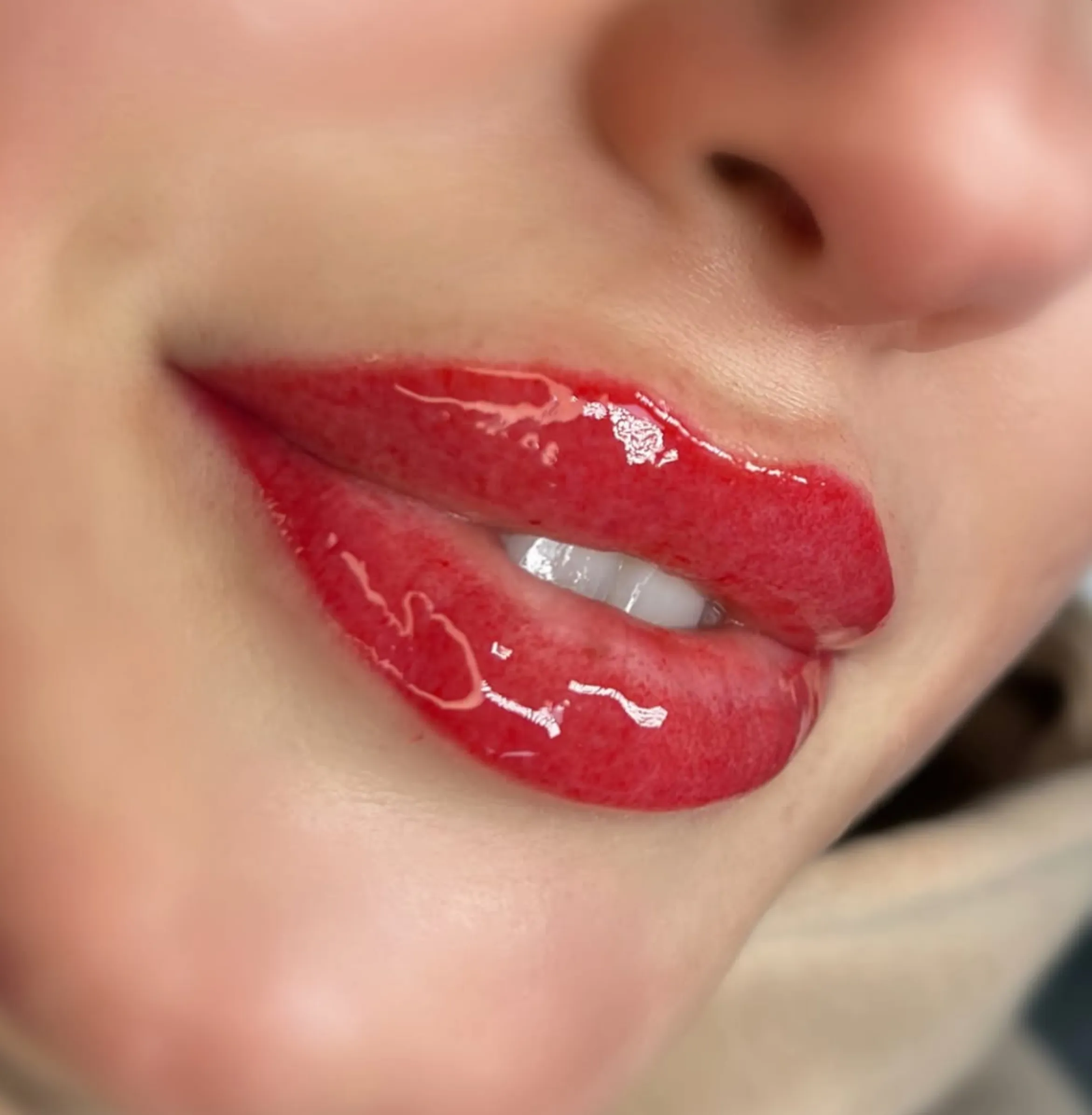 lip fillers before lip tattoo
