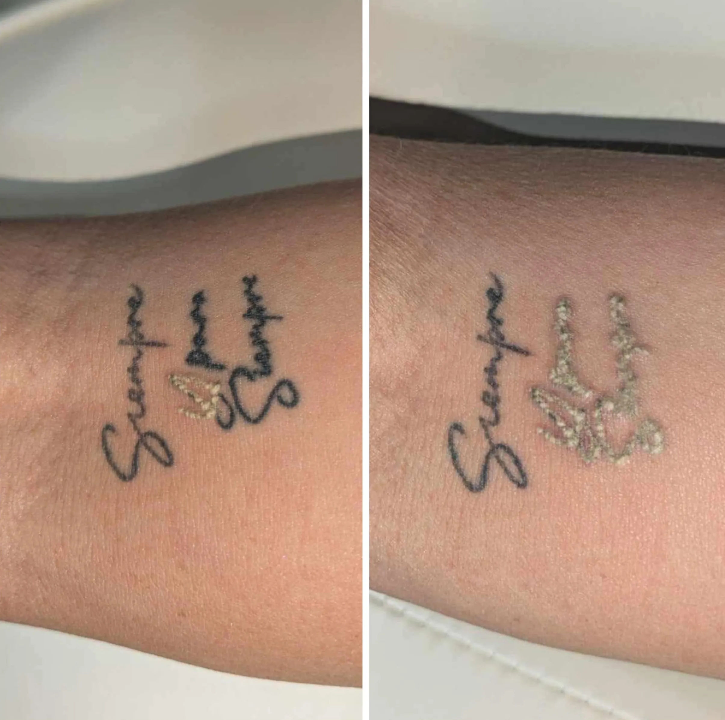 tattoo pigment and laser light