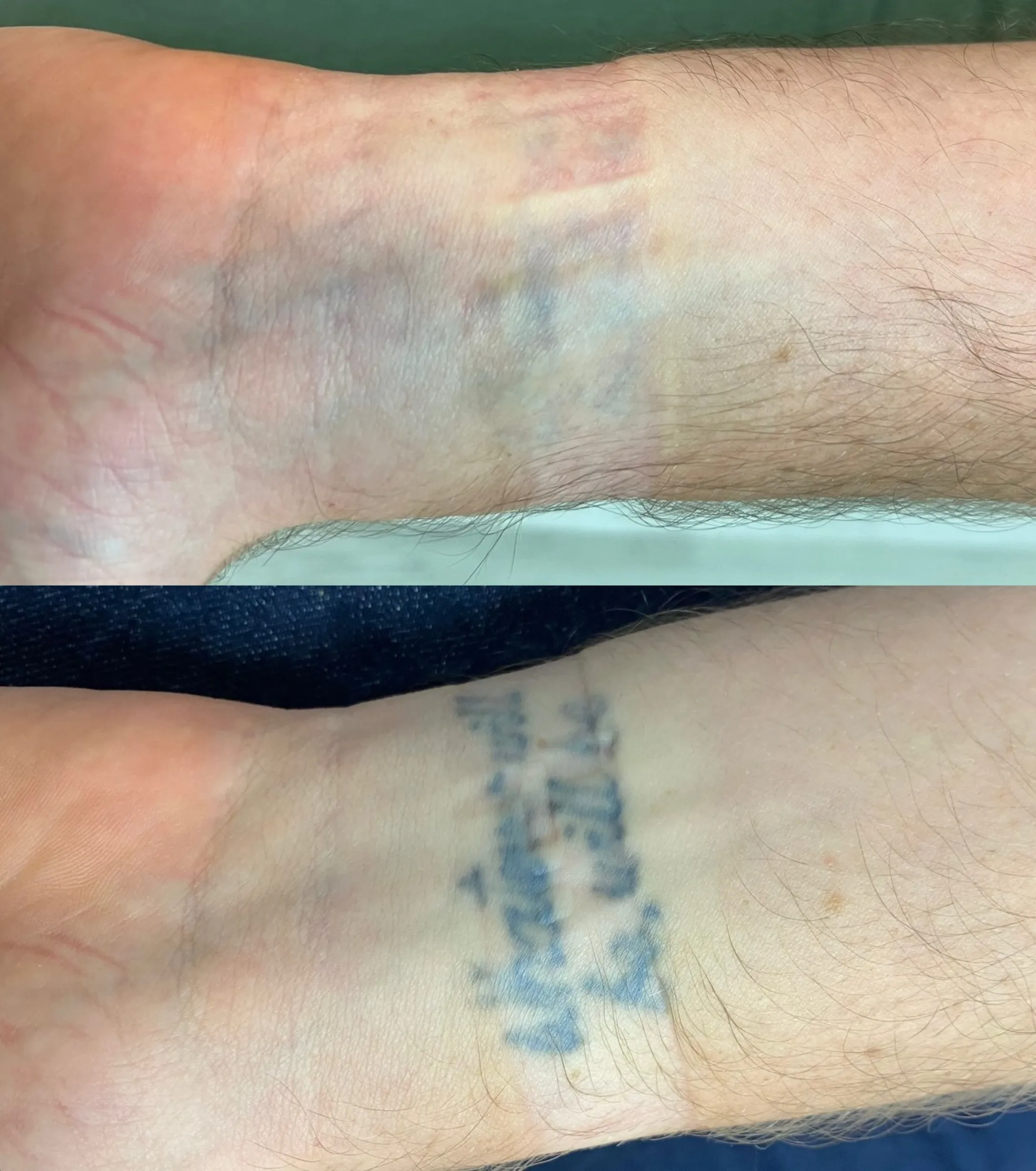 laser tattoo removal Brisbane