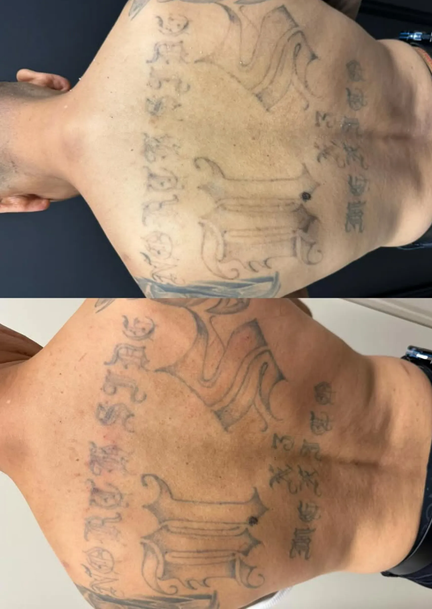 hardest tattoo colours to remove
