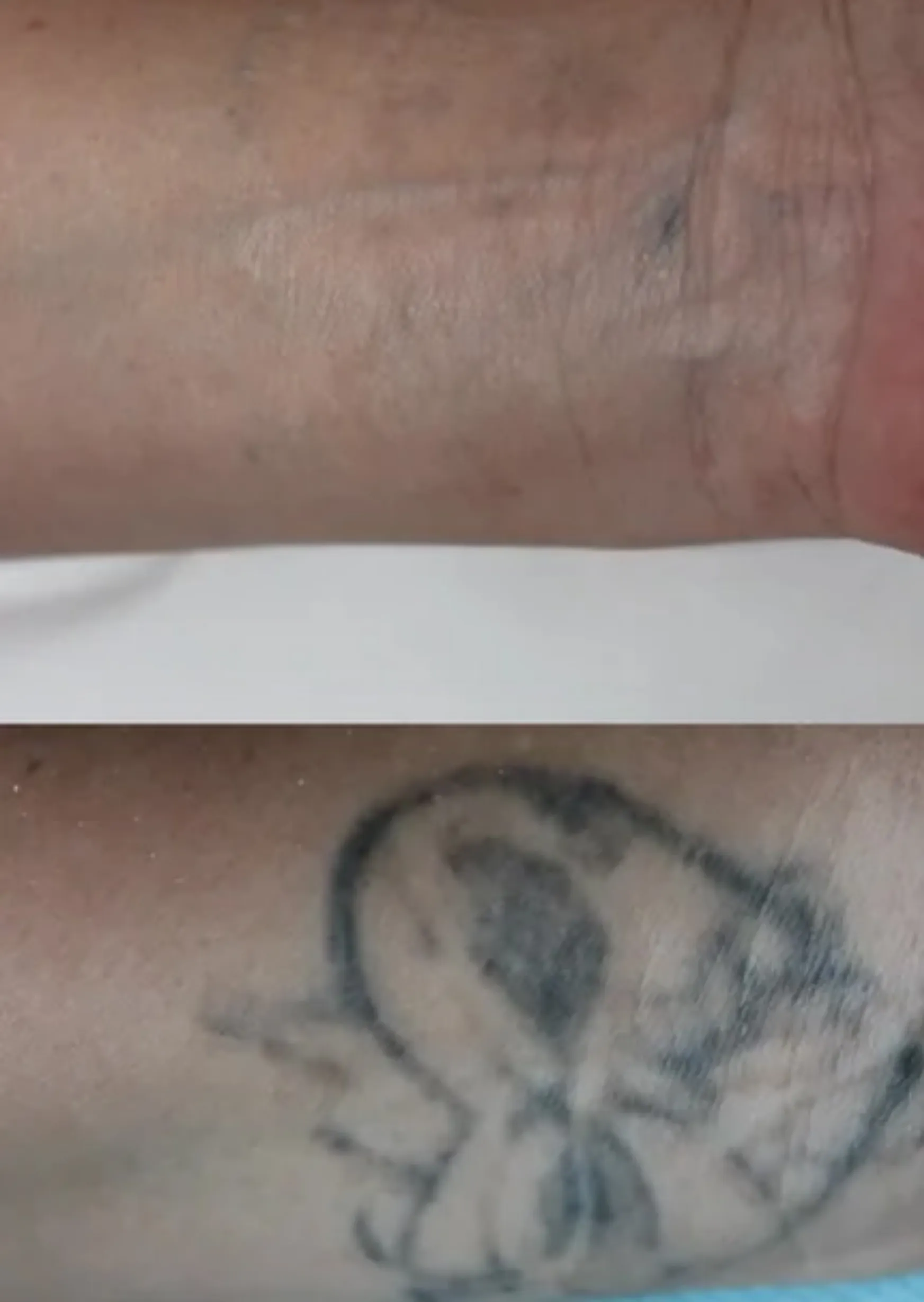 can all tattoo colours be removed