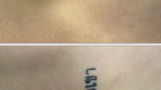 tattoo colour removal guide